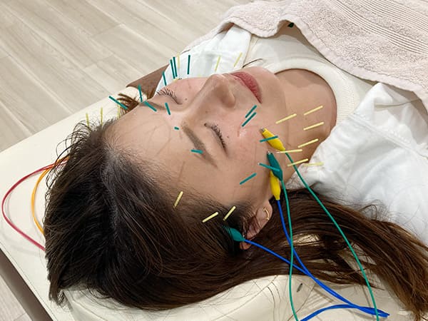 美容鍼施術